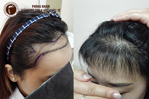 Hình ảnh trước và sau khi Cấy tóc tự thân Fue 06 tháng
