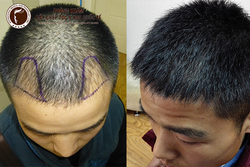 Thuốc chống hói đầu chỉ là phương án tạm thời, Cấy tóc tự thân hiệu quả thực sự (hình ảnh sau cấy tóc 08 tháng)