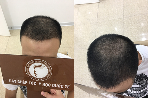 Hình ảnh Đào Bảo Nguyên sau khi cấy tóc tự thân 1 tháng