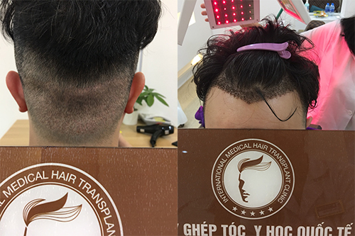 Hình ảnh vùng lấy tóc (sau gáy) và vùng cấy chữ M (trước trán) sau 6 ngày áp dụng phương pháp cấy tóc tự thân
