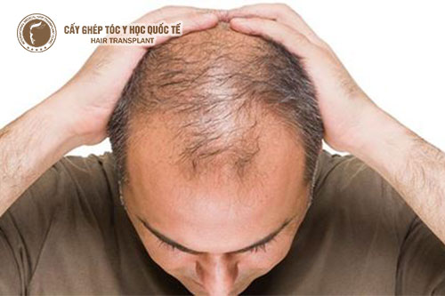 3 bài thuốc chữa hói đầu bằng Đông y tốt kích thích mọc tóc nhanh