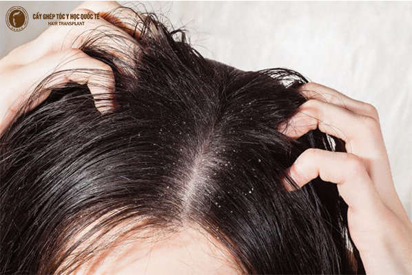 Cách trị rụng tóc và ngứa da đầu an toàn và hiệu quả