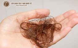 Rụng tóc bị bệnh gì và phương pháp điều trị 
