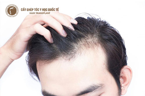 Rụng tóc da dầu phải khắc phục làm sao?