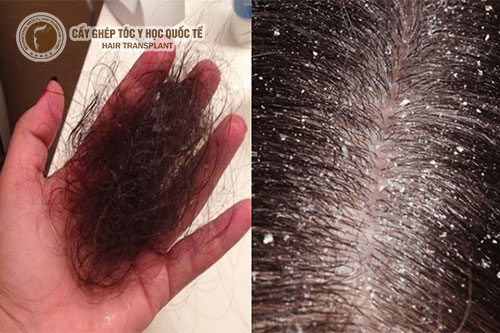 Rụng tóc gàu: Nguyên nhân và cách chữa trị hiệu quả