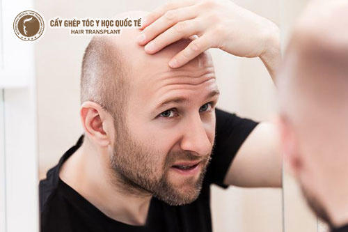 Rụng tóc ở nam giới Cách điều trị rụng tóc ở nam giới