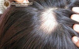 Nguyên nhân rụng tóc nhiều ở nữ giới và cách khắc phục hiệu quả