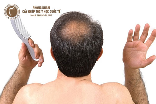 Tiết lộ 5 nguyên nhân phổ biến nhất gây rụng tóc ở nam giới
