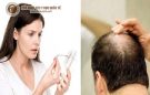 Gợi ý cách trị rụng tóc và hói đầu hiệu quả