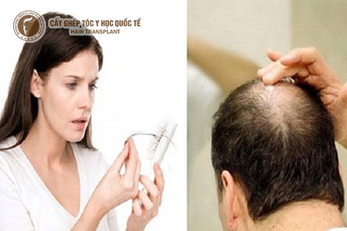 Gợi ý cách trị rụng tóc và hói đầu hiệu quả
