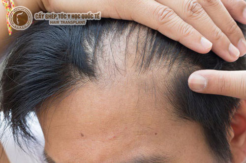 Rụng tóc kiểu rừng thưa: Nguyên nhân và cách khắc phục