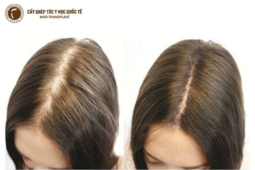 Hỉnh bên trái, rụng tóc cấp độ II - tiếp cận độ III.