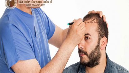 Xua tan nỗi lo hói đỉnh đầu ở nam giới