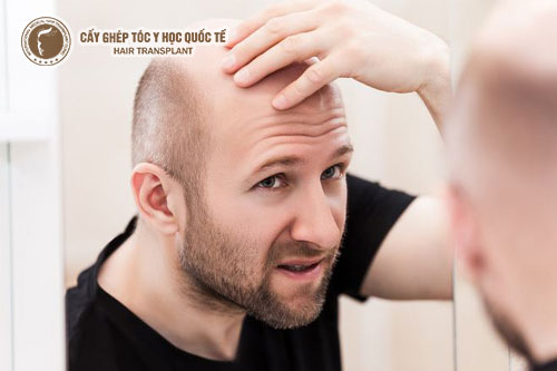 Đâu là phương pháp trị hói đầu ở nam giới hiệu quả nhất hiện nay?