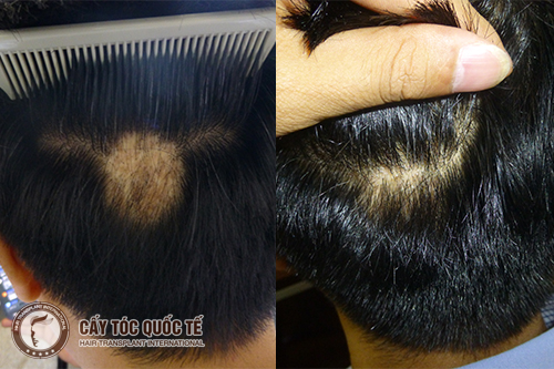 Chuyên gia giải đáp: Cấy tóc trên sẹo da đầu có hiệu quả trọn đời không?