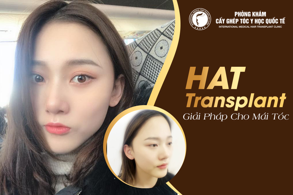 Chị Vũ Ngọc Bích, 26 tuổi, Hà Nội đã sở hữu đường chân tóc hài hòa với gương mặt sau 6 tháng cấy tóc Chị Vũ Ngọc Bích, 26 tuổi, Hà Nội đã sở hữu đường chân tóc hài hòa với gương mặt sau 6 tháng cấy tóc