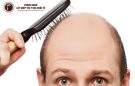 Cách chữa hói đầu ở nam giới cực hiệu quả ai cũng cần biết