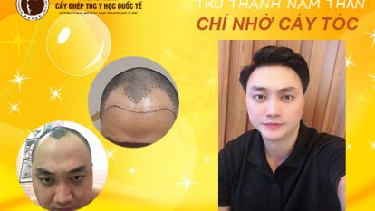Vương Quốc Anh – Trở thành nam thần chỉ nhờ cấy tóc tự thân
