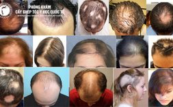 Sự thật về cấy tóc tự thân – Hiệu quả có đúng như lời đồn không?
