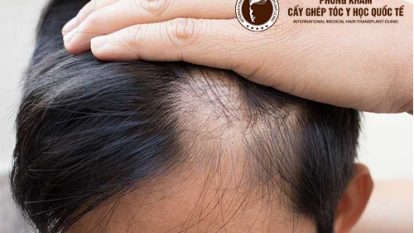 Rụng tóc 2 bên thái dương điều trị như thế nào?