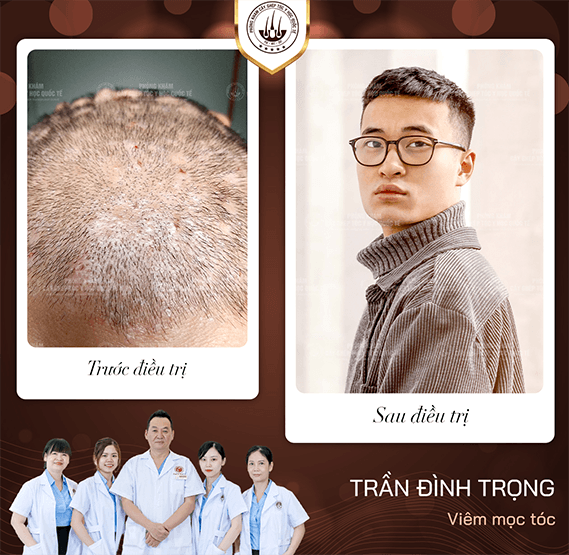 cấy lông body