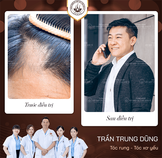 cấy lông body