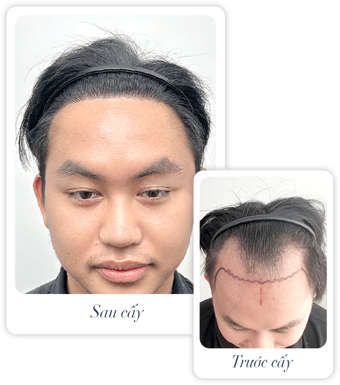 cấy ghép tóc y học