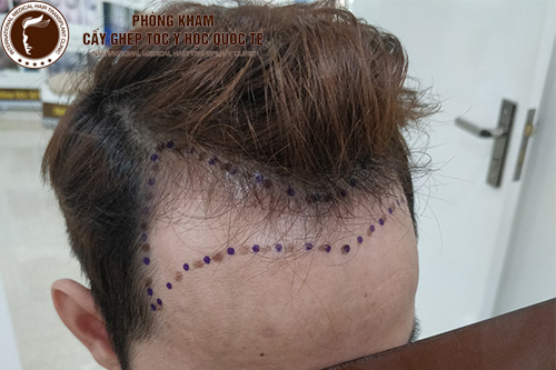 Bệnh hói đầu ở nam giới: Nguyên nhân và cách điều trị