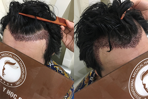 Hình ảnh anh Trần Thuận Tiến 27 tuổi sau khi cấy tóc tự thân 6 ngày