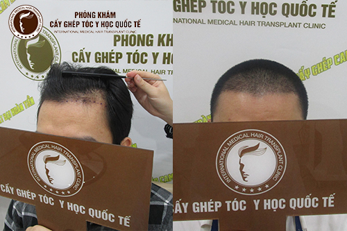Cấy ghép tóc tự thân là gì? Địa chỉ cấy ghép tóc uy tín tại Việt Nam