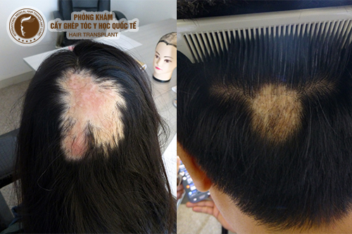 Cấy tóc trên sẹo biện pháp che khuyết điểm da đầu hiệu quả