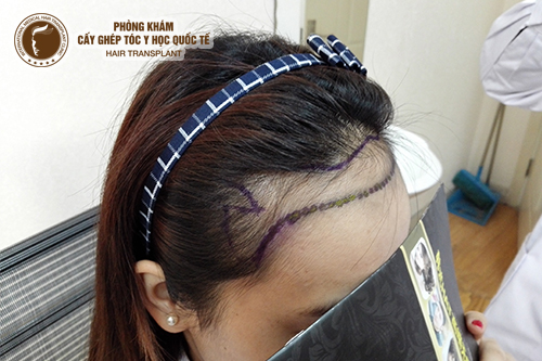 Nguyên nhân hói đầu ở nữ giới và 4 cách chữa trị hói đầu hiệu quả 