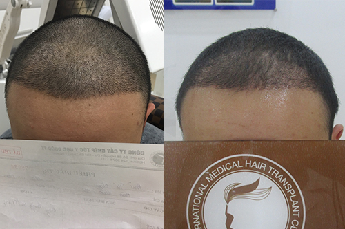 Đào Trung Nguyên sau thủ thuật Cấy tóc tự thân 1 tuần và 1 tháng