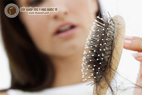 Những điều cần biết khi trị rụng tóc nội tiết