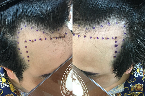 Cách phòng và điều trị rụng tóc 2 bên thái dương