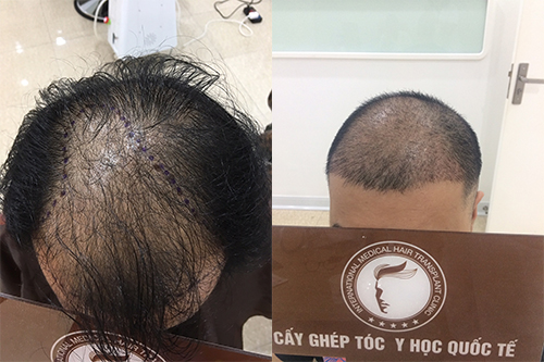 Chữa bệnh hói đầu bằng cấy tóc tự thân có hiệu quả không?