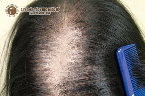 Nguyên nhân gây rụng tóc nhiều ở phụ nữ và giải pháp khắc phục