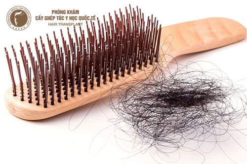 Học ngay 3 cách trị rụng tóc hiệu quả tại nhà