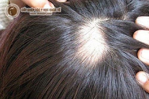 Điều trị rụng tóc từng mảng sao cho hiệu quả?