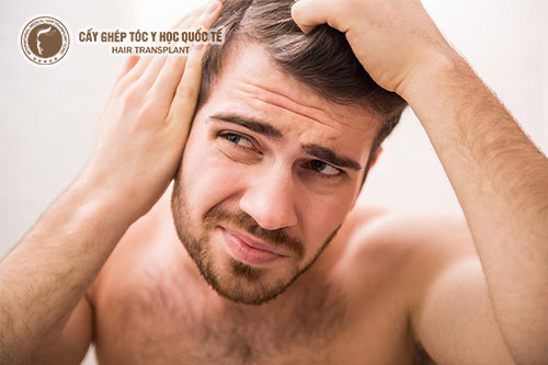 Bật mí cách điều trị rụng tóc ở nam giới hiệu quả nhất hiện nay