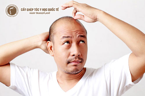 Review 3 loại thuốc trị hói đầu ở nam giới tốt nhất Nhật Bản