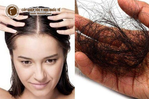 Đâu là cách trị rụng tóc nhiều hiệu quả từ thiên nhiên?