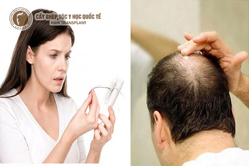 Thuốc đông y là giải pháp điều trị rụng tóc đỡ tốn kém nhất 