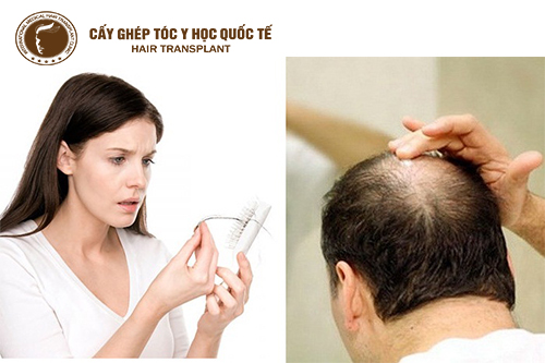 Tóc rụng nhiều là bệnh gì? Cách khắc phục tình trạng rụng tóc bệnh lý như thế nào?