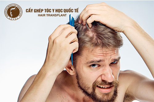 5 kiểu rụng tóc và triệu chứng hói đầu nam giới