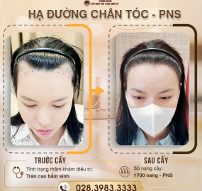 Có nên cấy tóc cho trán cao không?