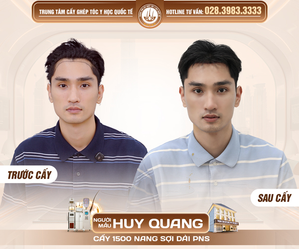 trước và sau khi cấy tóc