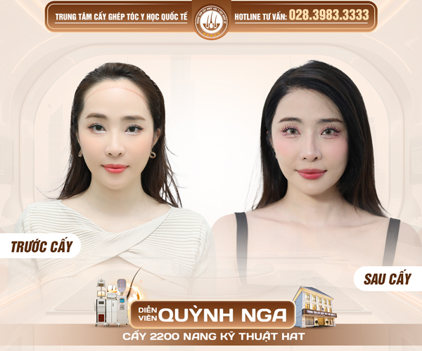 trước và sau khi cấy tóc